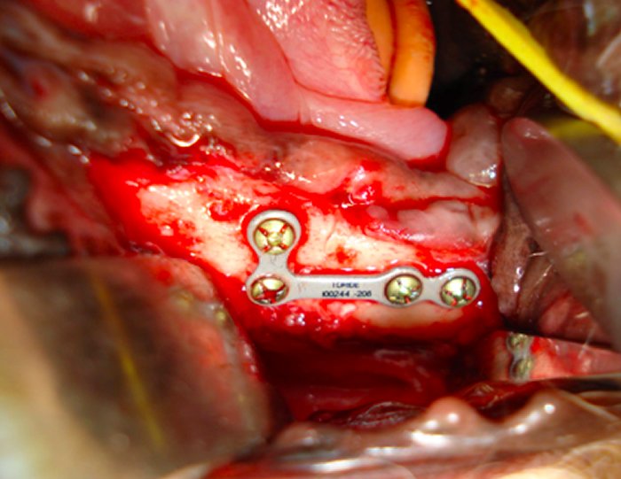 Uso de mini-placas de titânio em fratura de mandíbula de cão.
